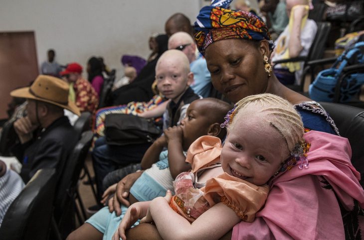 La communauté albinos célébrée ce 13 juin dans le monde