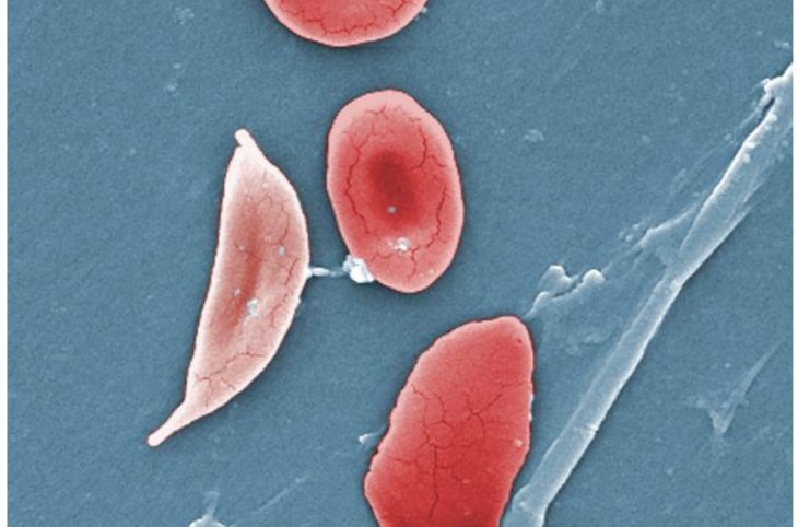 Drépanocytose, une maladie de sang